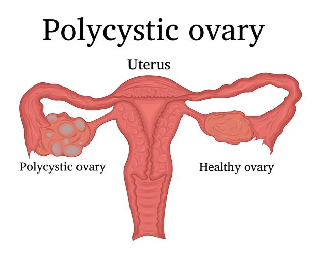 Polycystic Ovary Syndrome Causes
