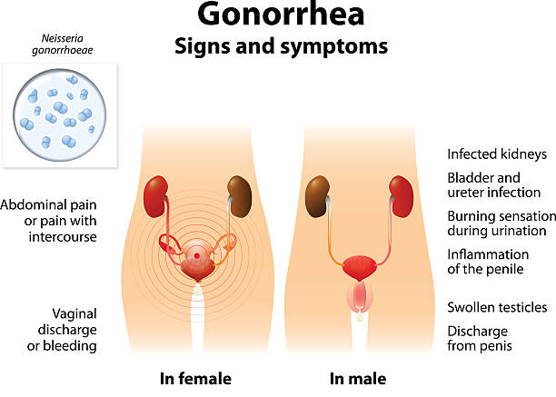 Symptoms of gonorrhea