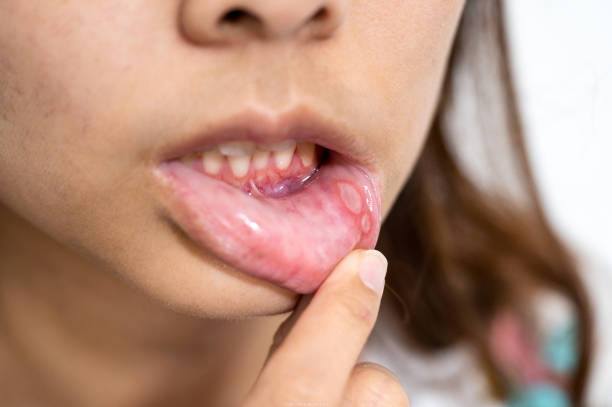 Canker Sores Causes and Treatments