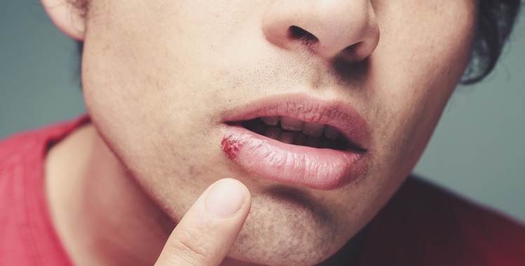 Fever Blisters