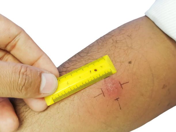 Purpose of the Tuberculin Test
