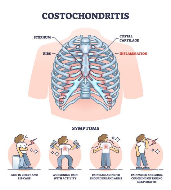 Costochondritis